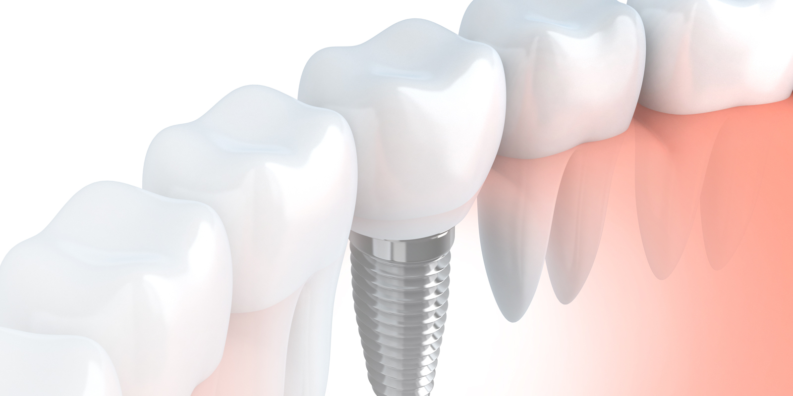 Dental Implants Now Dental