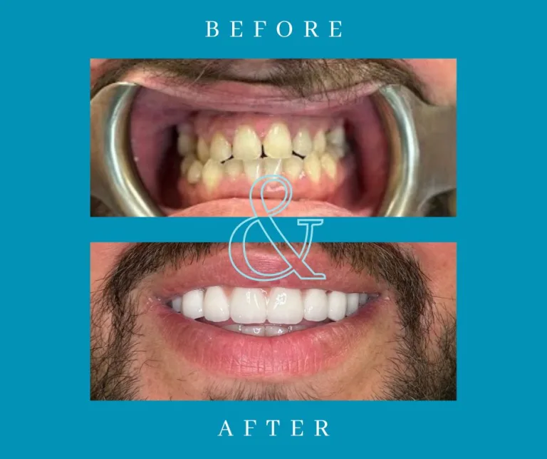 Dental Implants in Webster, TX | Candidacy, Timeline & Care