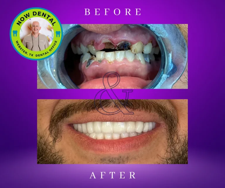 Invisalign in Webster, TX | Costs, Benefits & Timeline